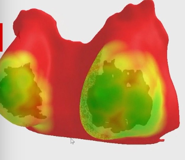 電腦畫面上以紅、黃、綠顏色標示的 3D 乳房與腫瘤模型